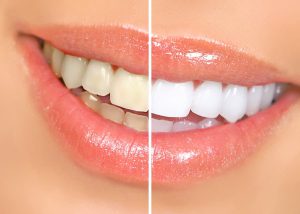 teeth whitening service